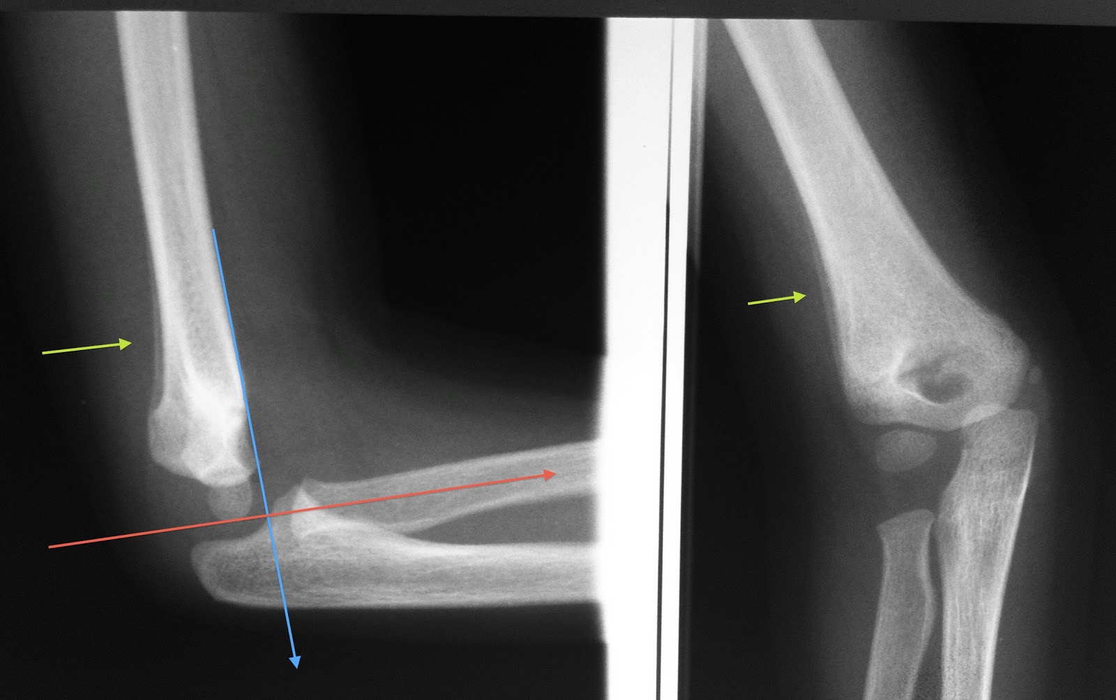 Radiologia Pediátrica: FRATURA SUPRACONDILAR DO COTOVELO