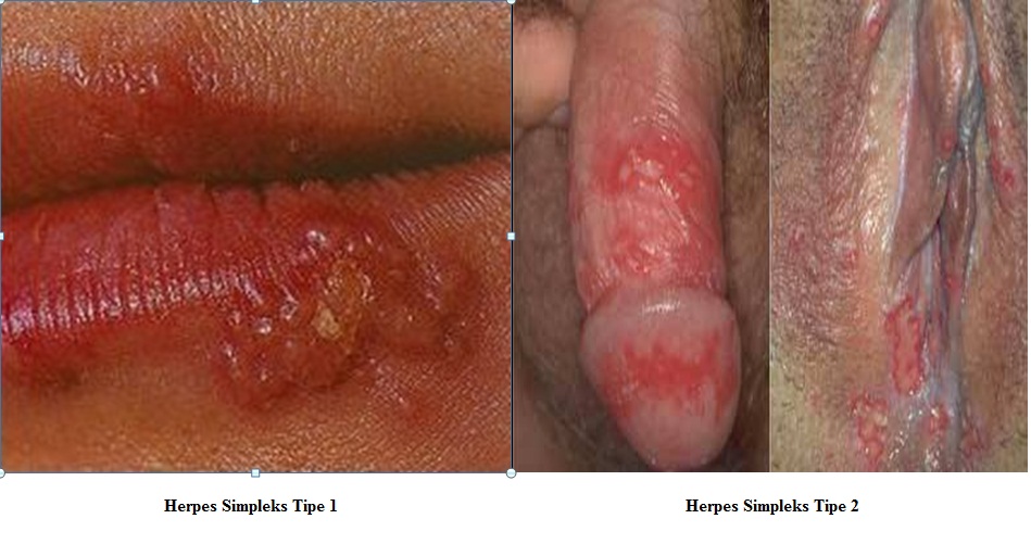 Herpes simplex 1 genital area,cough remedies for 2 year old,what can herpes cause. 