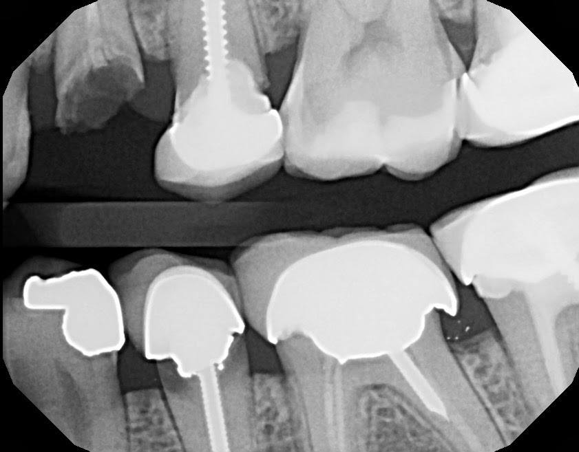Dental tipsMinimize the stress! Why do I need to replace this crown