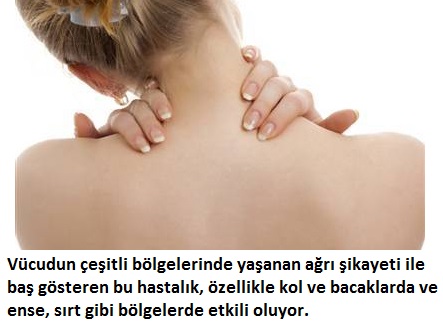 fibromiyalji belirtileri ve tedavisi
