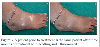 Tratamiento Exitoso del Vitiligo por Punción con 5 Fluorouracilo Topical-Caso 3