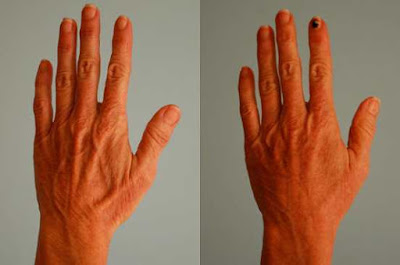 6 amazing hand rejuvenation photos