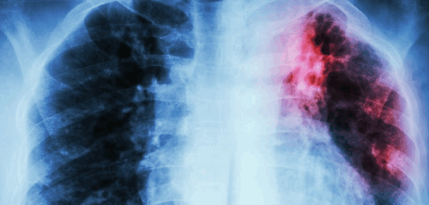 Tuberculosis: Causes, Symptoms, Diagnosis and Treatment