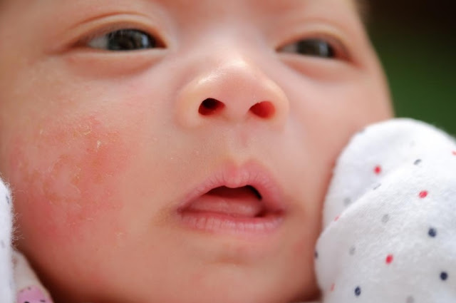 How to Get Rid of Baby Acne