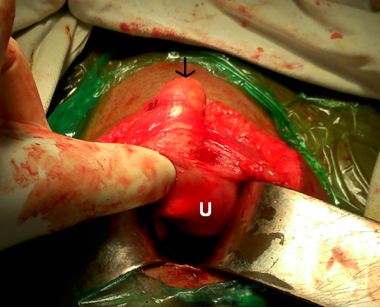 Journal of Postgraduate Gynecology & Obstetrics: Abdomino-Uterine Adhesion