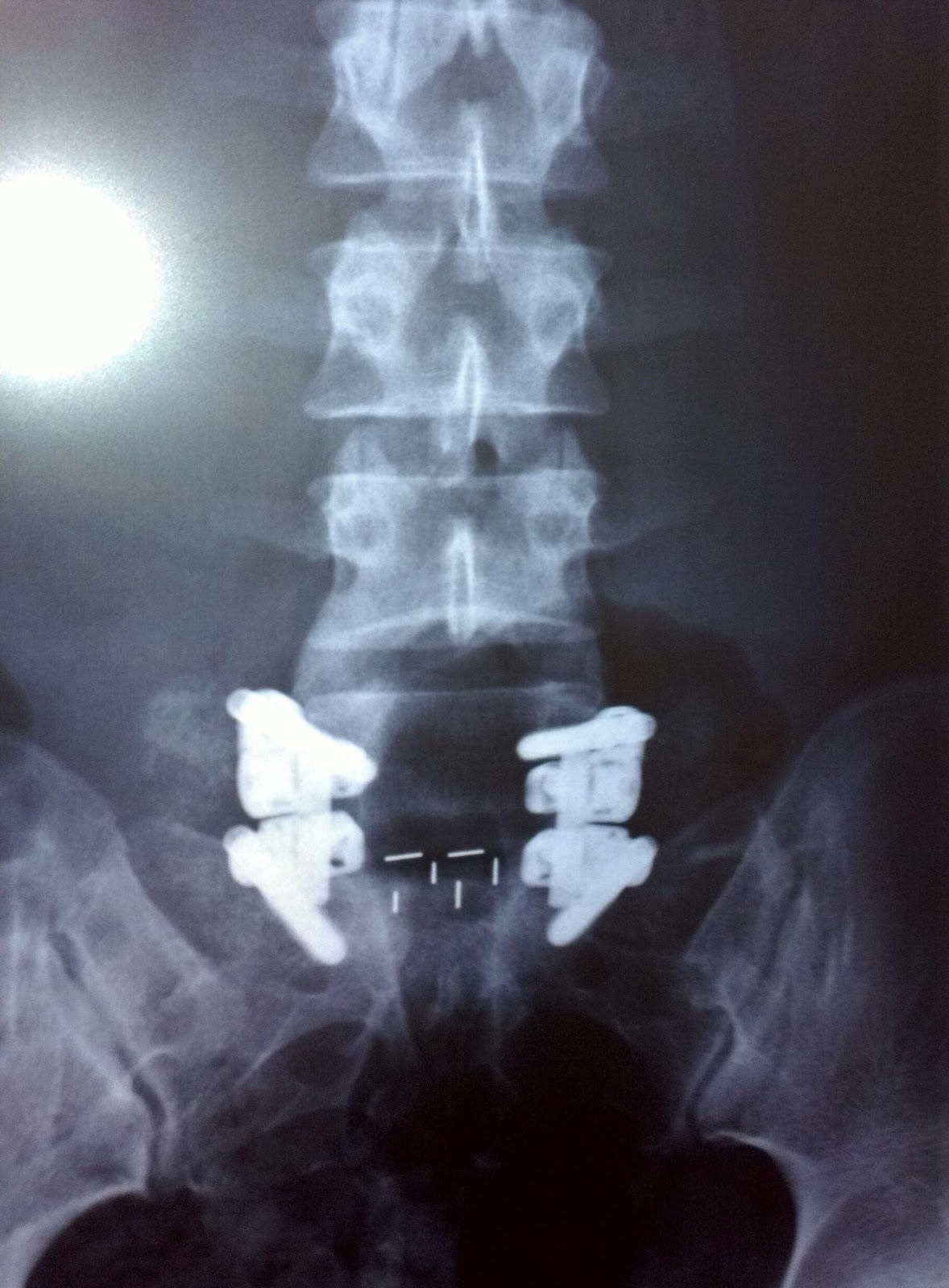 My L5S1 Spinal Fusion 1st set of xrays; second postop