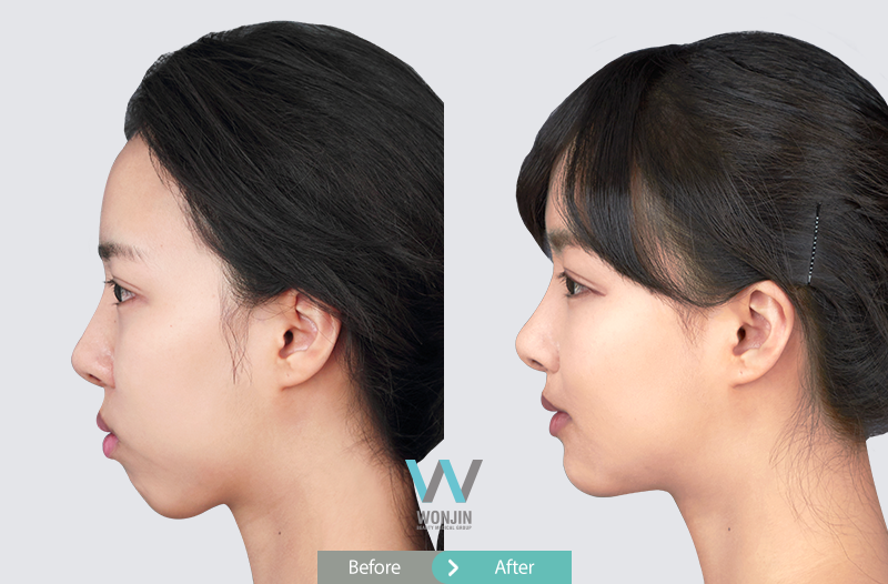 Челюстно лицевая операция до и после Two jaw surgery, improving the functionality is the key.