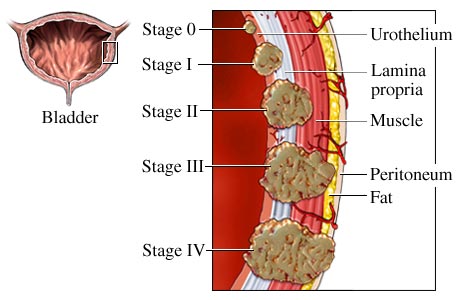 Bladder Cancer Stages