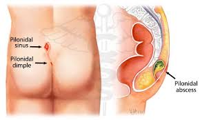 obat herbal untuk menyembuhkan pilonidal sinus obat herbal untuk menyembuhkan pilonidal sinus