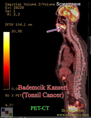 Bademcik kanseri - PET / BT - PET / CT - Tonsil cancer