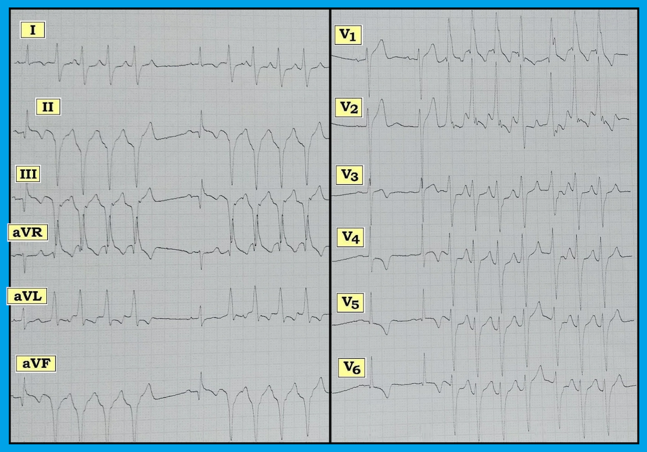 ECG Interpretation ECG Blog 151 (WCT VT SVT AV Dissociation