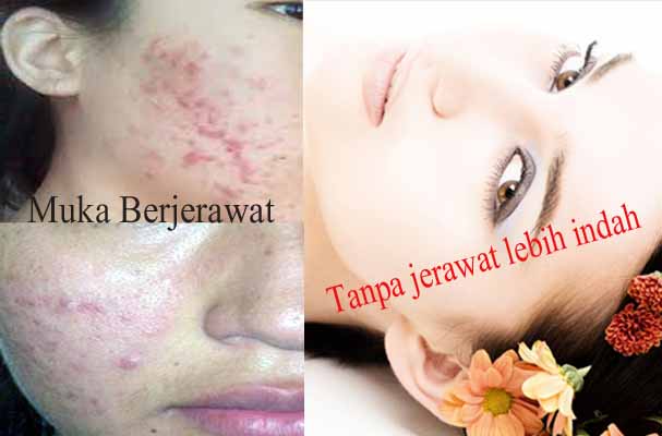 Cara menghilangkan jerawat secara alami