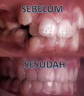 Wow! Video Ini Menunjukkan Bagaimana Kawat Gigi Bekerja Wow! Video Ini Menunjukkan Bagaimana Kawat Gigi Bekerja