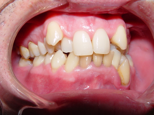 Ortodontia é Arte: Termoativado
