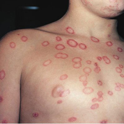 ringworm in humans pictures