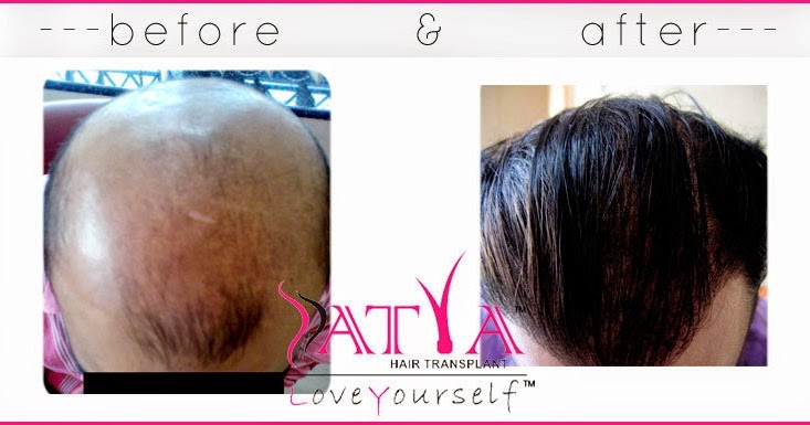 Satya Skin And Hair Transplantation How to look smart Satya Skin And Hair Transplantation How to look smart