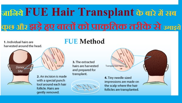 Fue hair transplant kya hai aur kharch kya hai, hair transplant cost in hindi language, fue hair transplant cost in india hindi