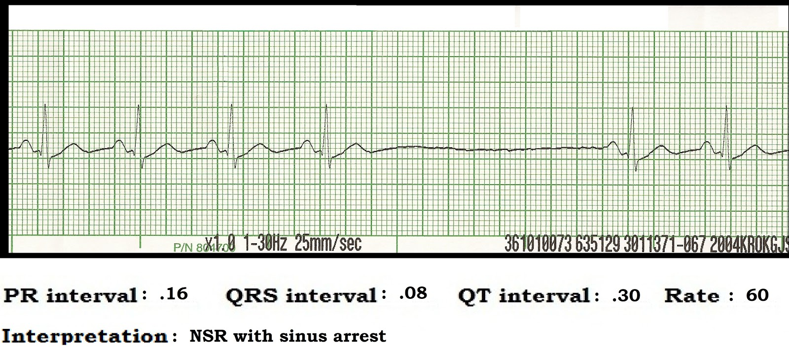 sinus rhythm ivcd sinus rhythm ivcd