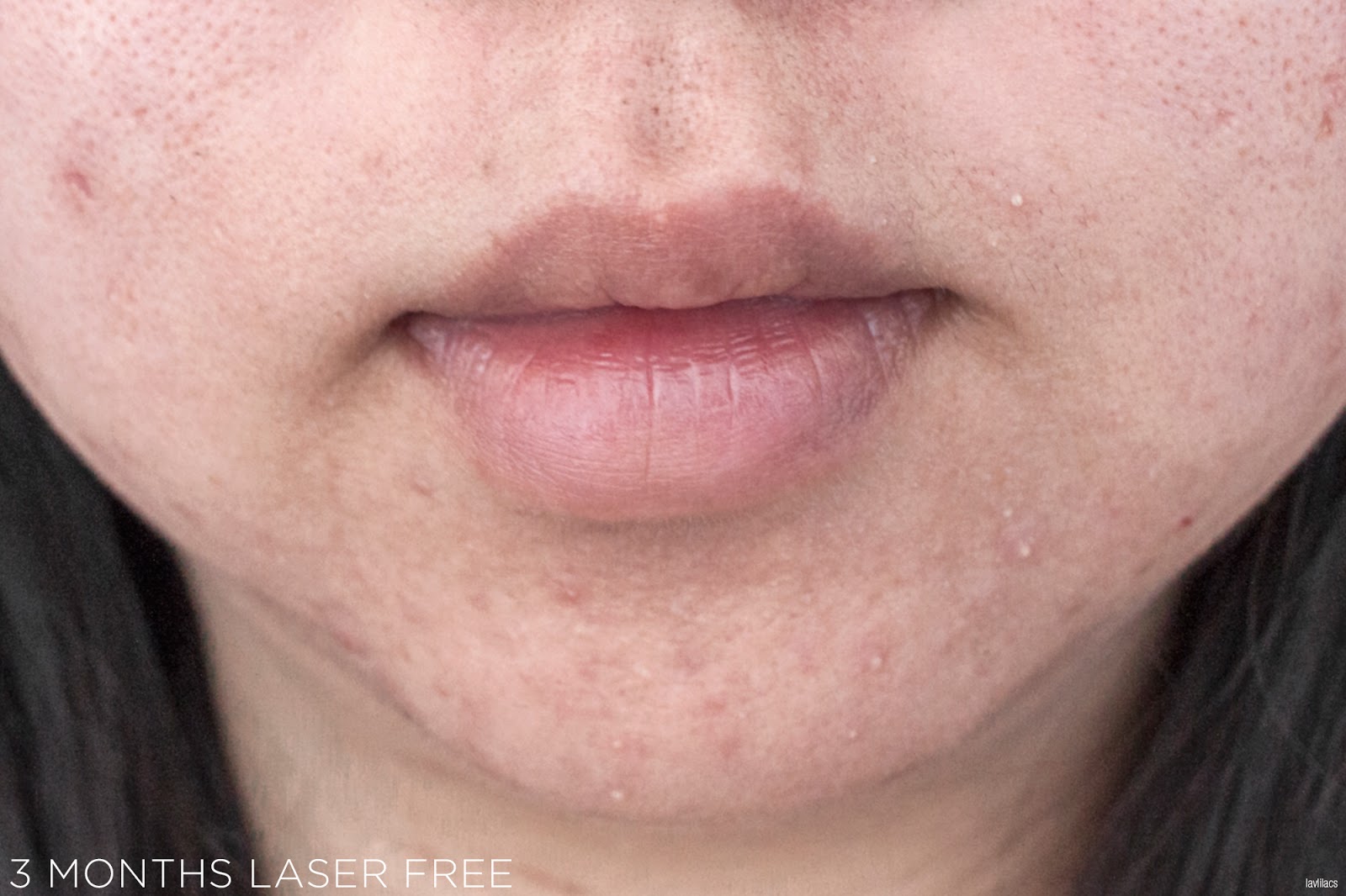 tria Hair Removal Laser Facial Hair 3 Months Laser Free Closeup