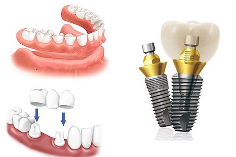 Kết quả hình ảnh cho thời gian cấy ghép implant