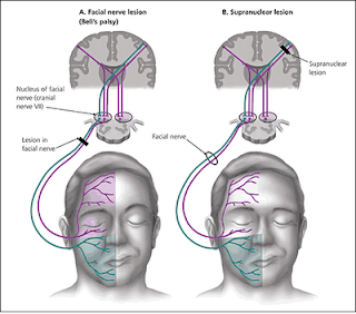 Facial Nerve Tract 70