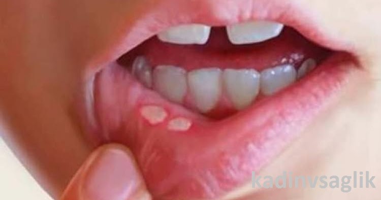 Ağız Yarası İçin Ne Yapılmalı
