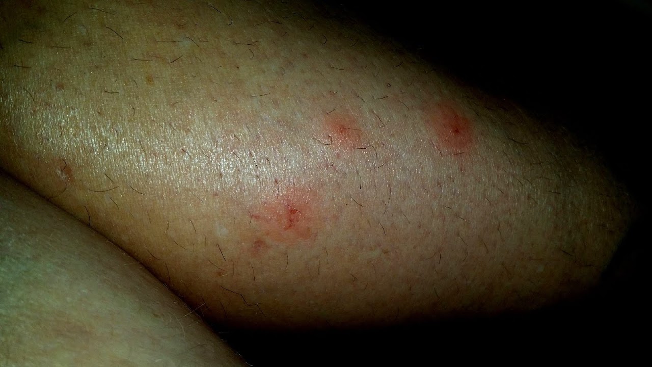 Cetirizine Zertec Side Effects Effect Choices