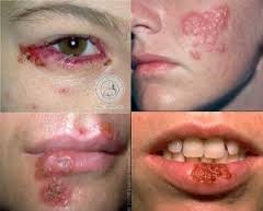 Herpes Simpleks Herpes Simpleks