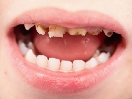 Anak demam tumbuh gigi kekal gigi susu patah - BILA LELAKI 