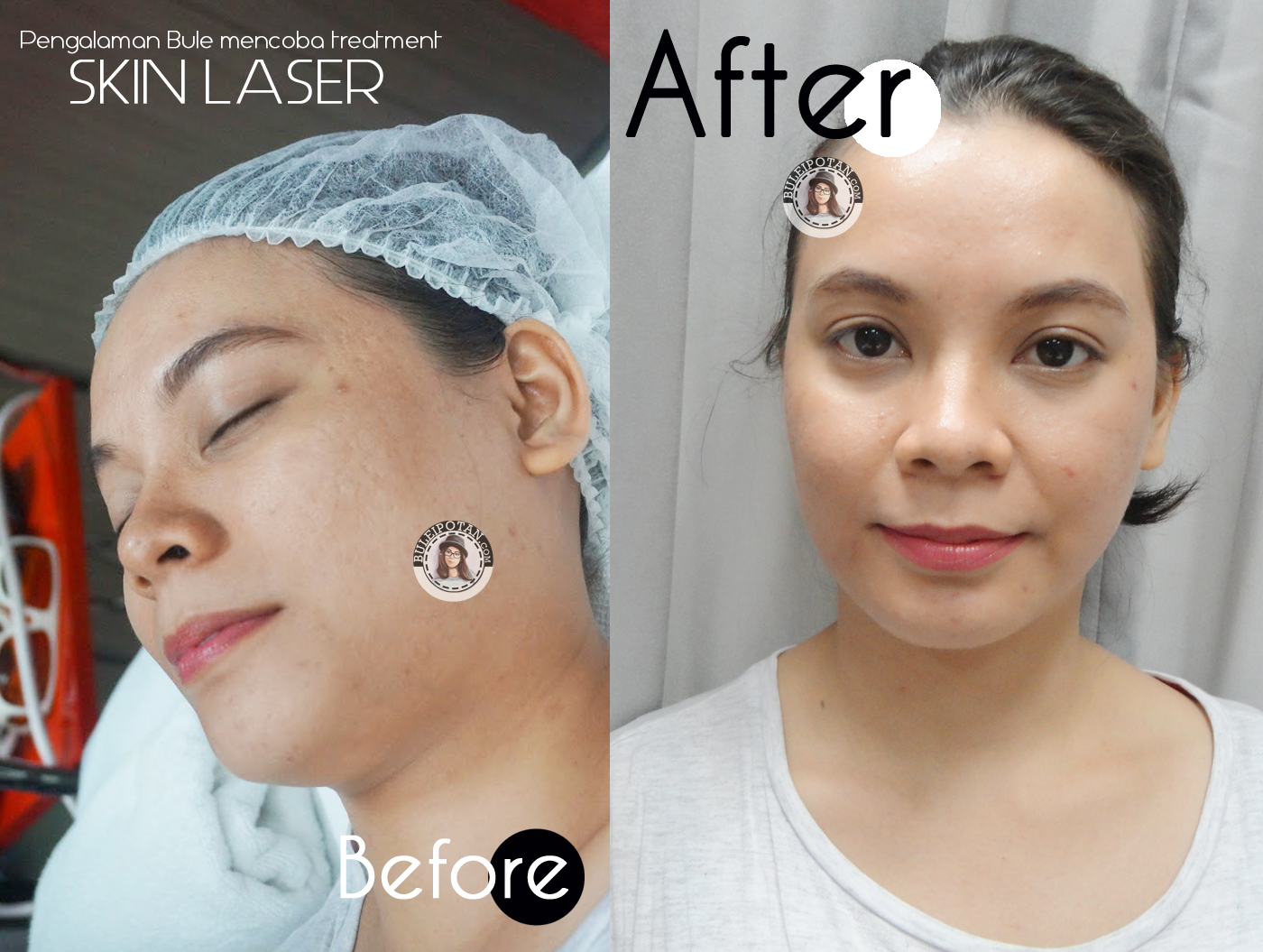 [ChitChat] Pengalaman Bule Laser Kulit Wajah di JPP Skin Laser Clinic