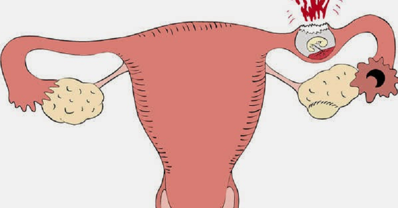 9+ Arti Mimpi Hamil Diluar Kandungan
