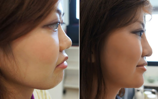 chin fillers singapore
