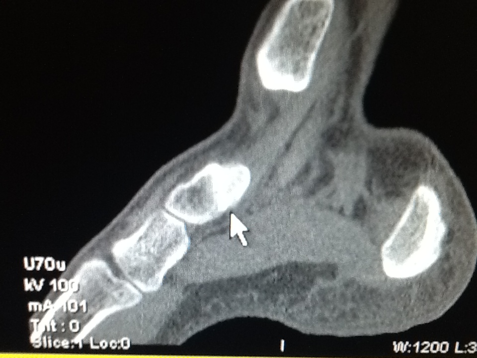 Foot and Ankle Problems By Dr. Richard Blake Images for Os Navicularis