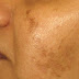 Get Rid of Freckles, Stains and Hyperpigmentation by Using This Natural Recipe Which Contains 2 Ingredients