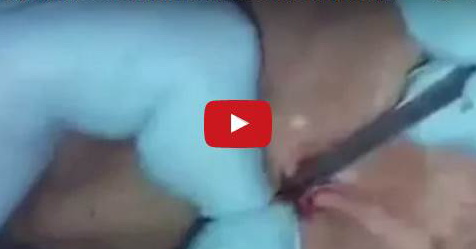 VIDEO: Ngeri! Beginilah Keadaan Ketika Susuk Dikeluarkan Dari Tubuh Manusia