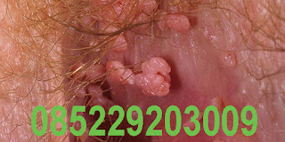 obat kutil Obat Kutil - di kemaluan kelamin penis vagina luar dalam, anus dubur, terbukti kutil hilang tanpa operasi, obat untuk kutil kelamin untuk pria, wanita, laki-laki, perempuan, ibu hamil menyusui mengandung, obat kutil terbaik terpercaya aman tanpa efek samping