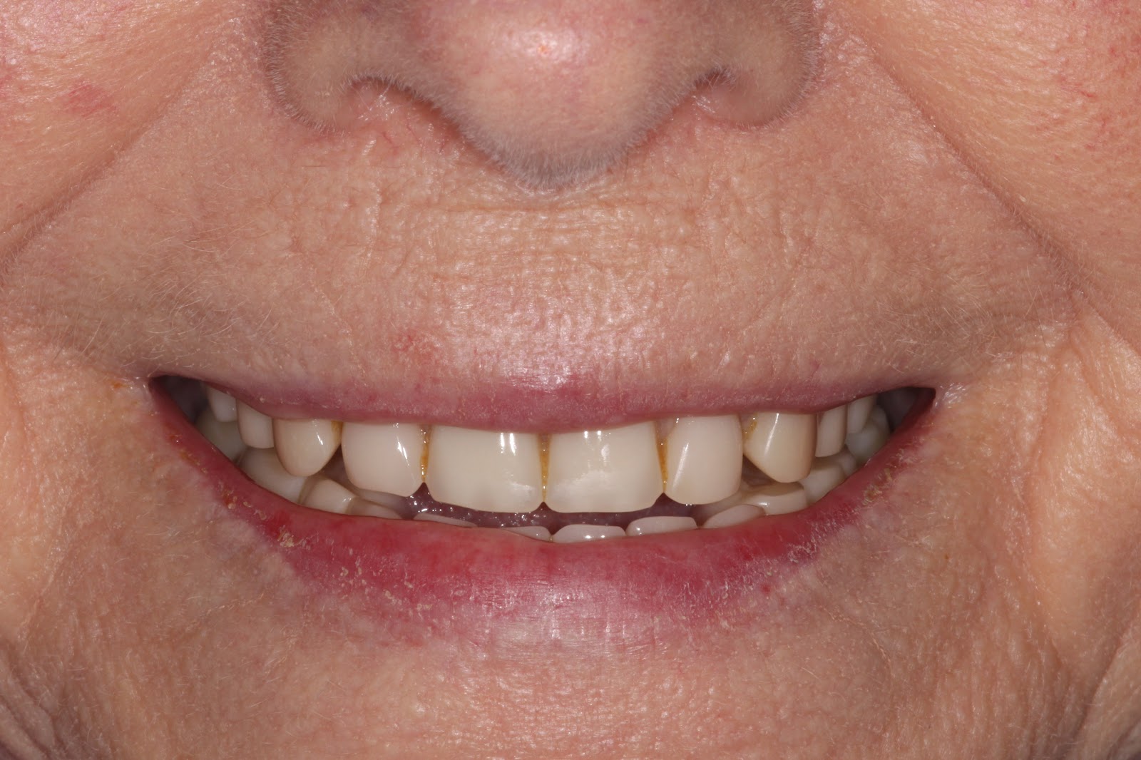 Boise Idaho Prosthodontics Maxillary Complete Denture / Mandibular
