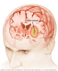 Brain Cancer Picture
