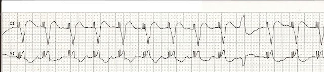 Occasional pvc during exercise Occasional pvc during exercise