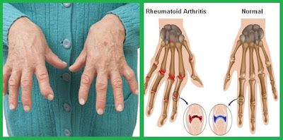 Apa Itu Rheumatoid Arthritis: Penyebab, Gejala, Pengobatan - Pasien Sehat
