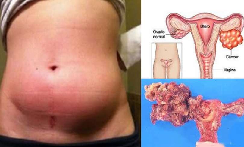 Síntomas de apendicitis mujeres
