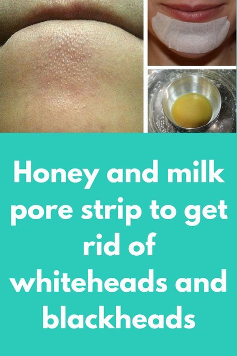 How To Get Rid Of Whiteheads Naturally At Home
