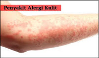 Alergi Kulit Inilah Penyebab, Gejala dan Cara Mengatasinya Alergi Kulit Inilah Penyebab, Gejala dan Cara Mengatasinya