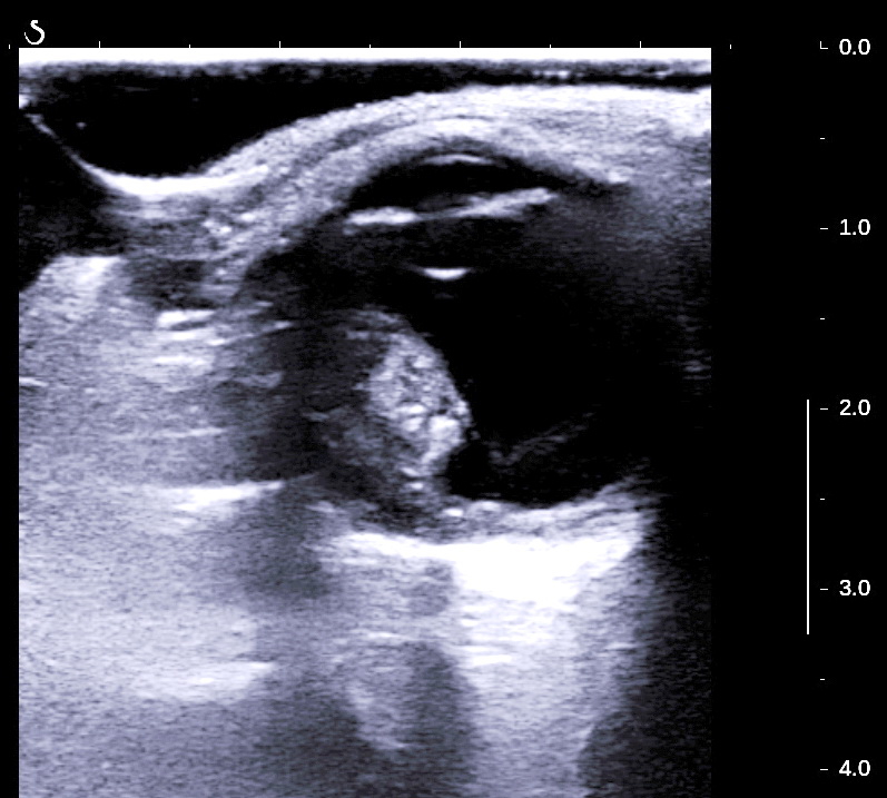 VIETNAMESE MEDIC ULTRASOUND CASE 499 RETINOBLASTOMA, Dr PHAN THANH