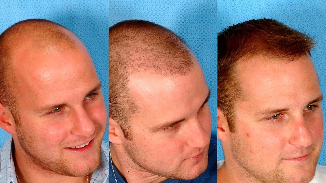 How Much Is Hair Restoration Surgery How Choices