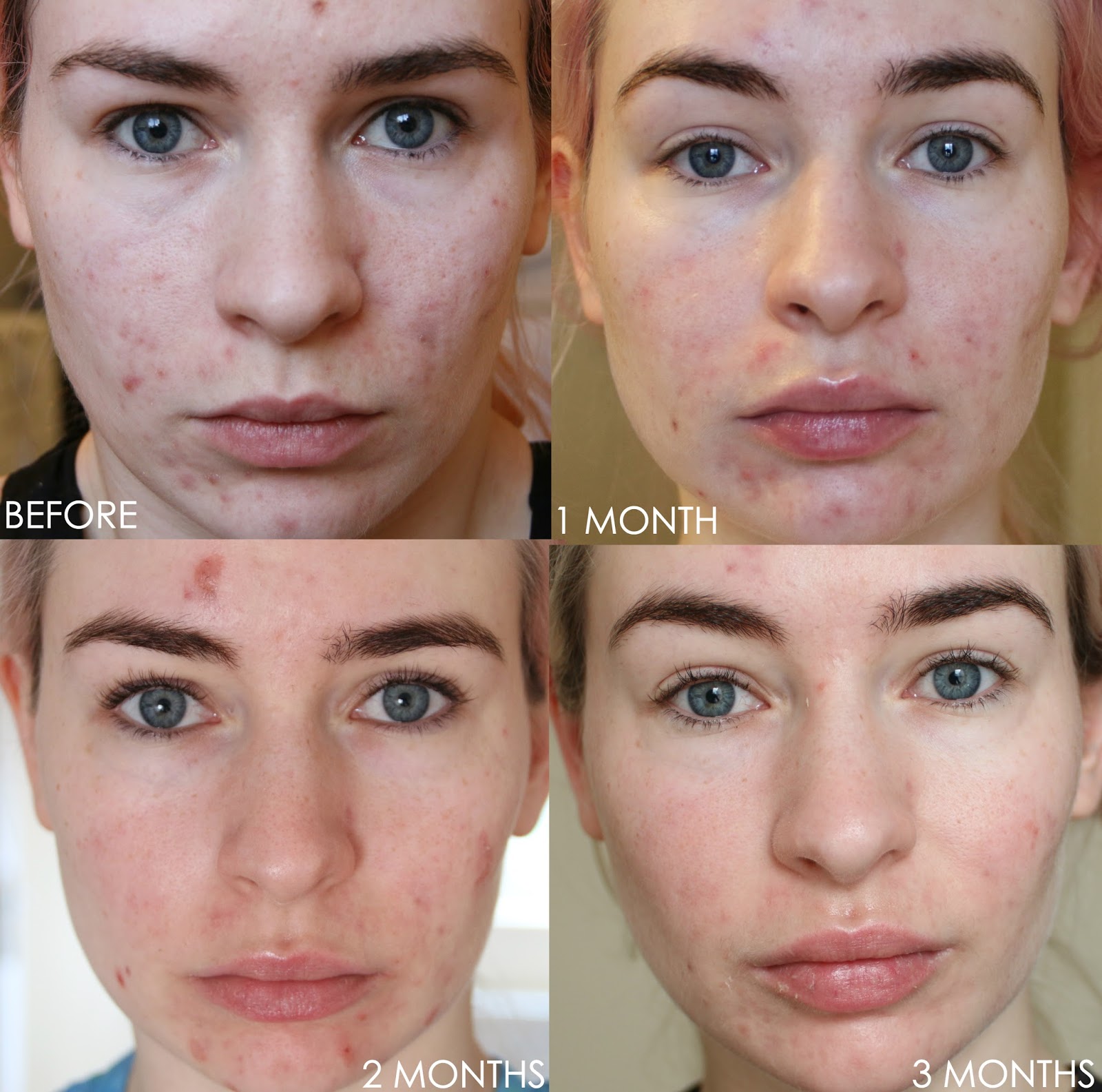 accutane before after