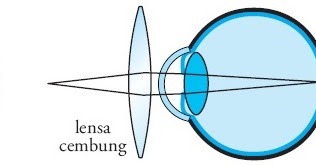 Tendința problemelor de vedere - Boli oculare miopie hipermetropie