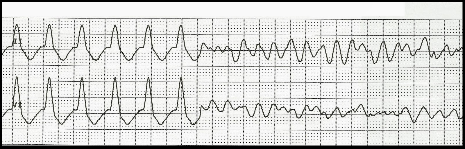 Practice Rhythm Strips 282