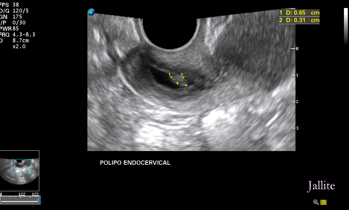 Doble Polipo Endometrial Doble Polipo Endometrial