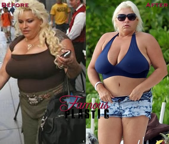 Beth Chapman Tummy Tuck Plastic Surgery Before And After Star.